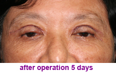 plastic-surgery-blepharoplasty